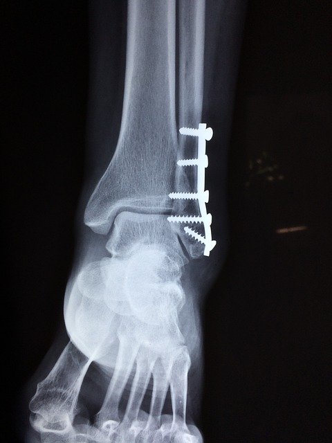 Image of a broken ankle to support text