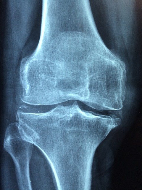 Xray Image of aq damaged knee to support thr text