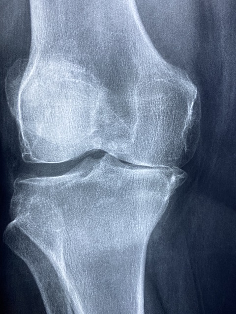 Image of a knee joint with arthritis to support the text