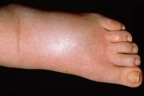 The most common reason for swollen feet or ankles is poor circulation. In older people, it could mean their blood vessels are weakening. It could also be an indication of a blood clot blocking the veins.