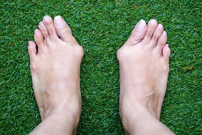 These are painful bony lumps that grow along the inside of your foot at the joint where your big toe meets your foot. Bunions grow slowly as the big toe angles inward. 