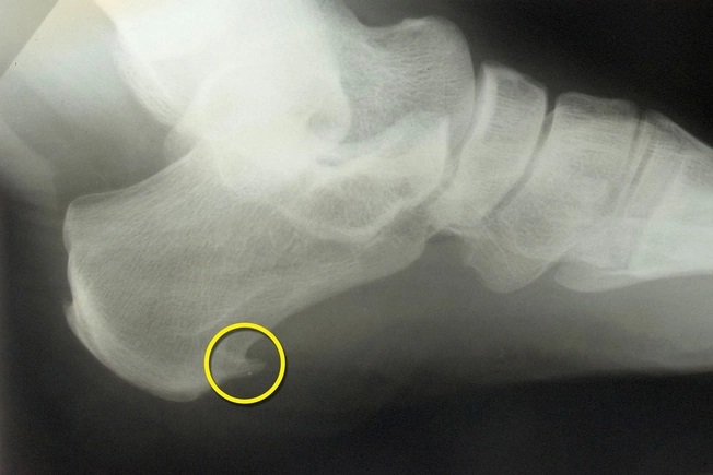 Bone spurs, on the other hand, are growths at the edge of the bones of your foot, often at your heel, mid-foot, or big toe. 