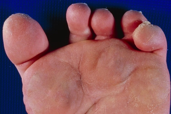 This kind of misshapen foot is similar to hammertoe. But instead of just the middle joint, claw toes also affect the joints closest to the tips of your toes.