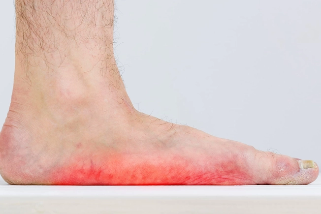 Some ageing adults get flat feet because of an injury or things like obesity, diabetes, and high blood pressure. Tendons that support your arch get damaged and flatten your feet. 