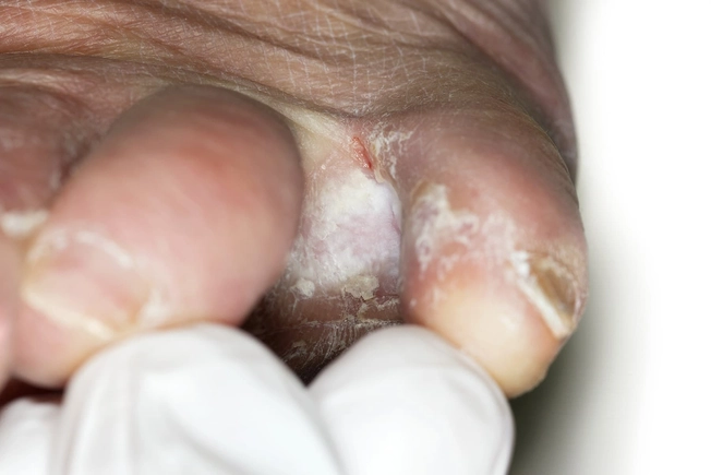 Less elastic skin and weaker immunity can invite more fungal infections in seniors. The sole of your foot may scale and itch. If it’s not treated, the infection can spread to your toenails. 