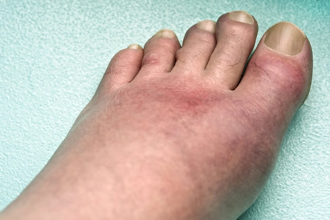 Gout is a painful form of arthritis that is most common in middle-aged men. It happens when a waste product called uric acid collects as crystals, often in the big toe. 