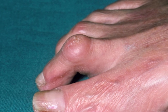 It’s an abnormal bend in the middle joints of your toe. It’s usually your “second” toe, next to the big one. But it also can affect the third, fourth, and fifth toes. 