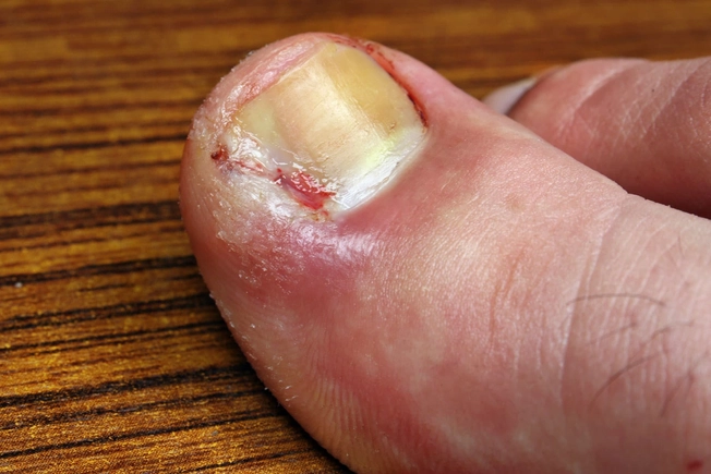 Ingrown toenails  Sometimes, the side of a nail (usually on the big toe) grows into the skin. Generally, it can happen at any age, but it’s more common in older folks. 