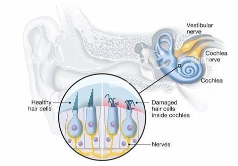 hearing loss is due to many different factors and changes in your ear that happen over time. Thus, one of the main changes is to tiny hairs in part of your inner ear called your cochlea. 