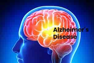Types of Dementia
. Alzheimer’s disease is the most common type of dementia. Between 60 and 80 percent of cases of dementia are caused by this disease, 