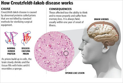 Creutzfeldt-Jakob disease (CJD) is one of the rarest types of dementia. Only 1 in 1 million people are diagnosed with it every year, according to the Alzheimer’s Association. 