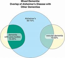 Mixed dementia refers to a situation where a person has more than one type of dementia. Mixed dementia is very common, and the most common combination is vascular dementia and Alzheimer’s. 