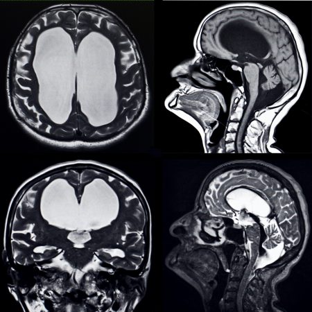 Normal pressure hydrocephalus (NPH) is a condition that causes a person to build up excess fluid in the brain’s ventricles. Types of Dementia 2 Normal pressure hydrocephalus (NPH) is a condition that causes a person to build up excess fluid in the brain’s ventricles. The ventricles are fluid-filled spaces designed to cushion a person’s brain and spinal cord. They rely on just the right amount of fluid to work properly. When the fluid builds up excessively, it places extra pressure on the brain. This can cause damage that leads to dementia symptoms.