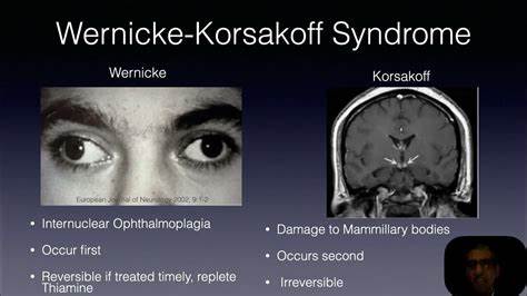 The two conditions are linked and are usually grouped together as one condition, known as Wernicke-Korsakoff syndrome. Though the symptoms resemble those of most other types of dementia, Wernicke-Korsakoff syndrome is unique in that it is preventable, and, when addressed early, treatable.