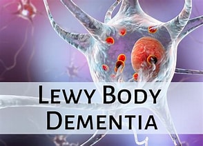 Dementia with Lewy bodies, also known as Lewy body dementia, is caused by protein deposits in nerve cells. This interrupts chemical messages in the brain and causes memory loss and disorientation.