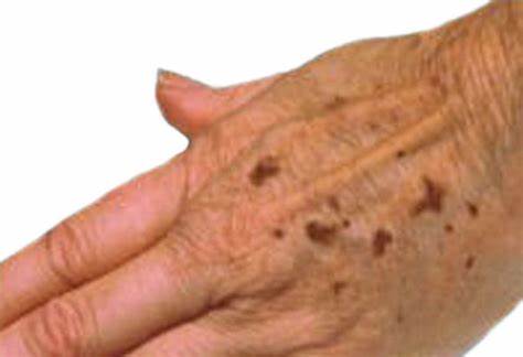 Here, Age spots are flat brown, gray, or black spots on the skin. they usually occur on sun-exposed areas, like the backs of your hands and your face. 