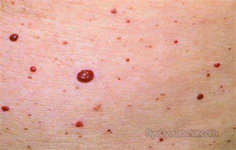 Illustration of these often hated skin spots