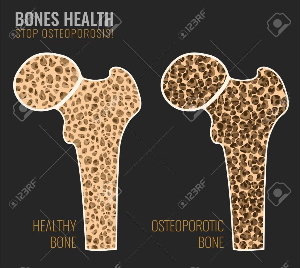 Phosphorus and calcium are the two most important minerals to bone health. Together, they aid in bone development and mineralization and also increase bone density and strength.