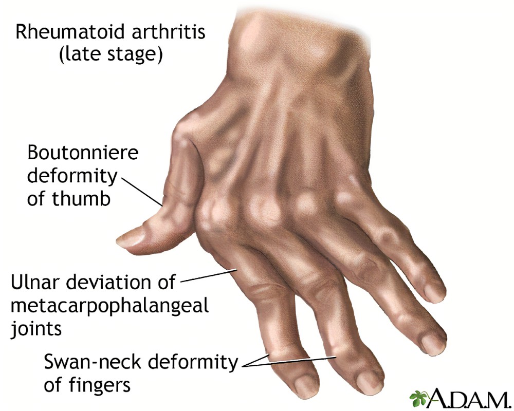 pineapples are a health food, Arthritis affects more than 54 million U.S. adults. Consequently, many types of arthritis exist, but most involve joint inflammation. Here, bromelain’s anti-inflammatory properties may provide pain relief for those with inflammatory arthritis. 