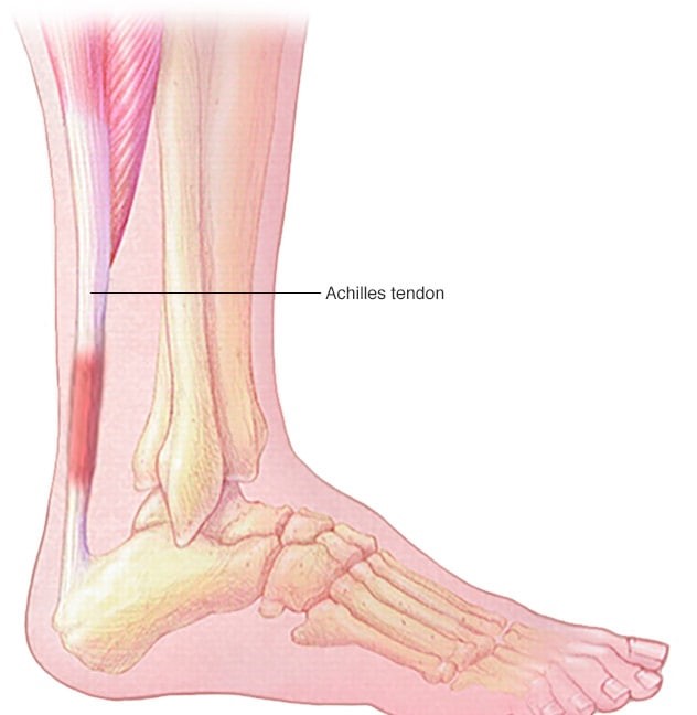 Achilles tendonitis is another common foot issue. This condition occurs in the back of the foot in the area where the tendon inserts into the heel bone and the area 1 to 3 inches above where the blood supply is at its lowest. 