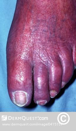 Acrocyanosis is a condition that causes the extremities, such as the toes, to turn blue. This occurs when the blood vessels constrict, preventing blood flow and oxygen from moving through that part of the body.