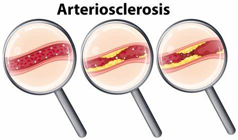 Arteriosclerosis occurs when the arteries harden, and blood cannot travel through them easily.