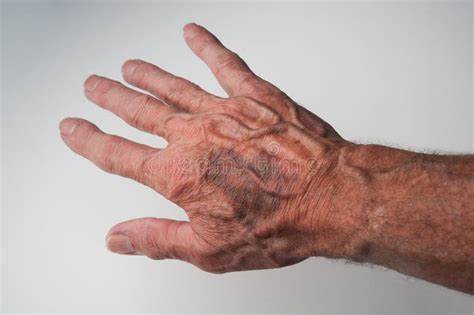 Bruising, When it’s on the back of your hands and arms, doctors call it "actinic purpura," "solar purpura," or "Bateman's purpura." A light knock can cause it, and it’s more common on thin, wrinkled, or sun-damaged older skin. You’re also more likely to bruise if you take drugs like aspirin or other blood thinners, or drink alcohol often. 