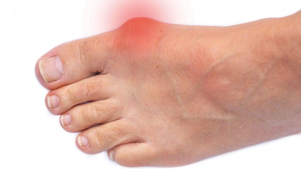 Seniors. Bunions – also known as hallux valgus – are very common in all active age groups. They are painful, bony bumps that develop on the outside of the big toe joint. They tend to develop slowly over time, as pressure on the big toe joint pushes the toe inward, toward the second toe.