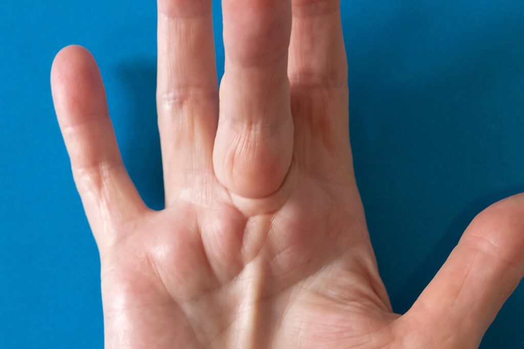 Dupuytren's Contracture, This is when the tissue just under the skin of your hand gets unusually thick. It can cause your fingers -- most often the ring and pinky fingers -- to bend into your palm. You may get lumps or thick cords (like string) in your palm as well. It sometimes affects the top of your knuckles or the soles of your feet, too. 