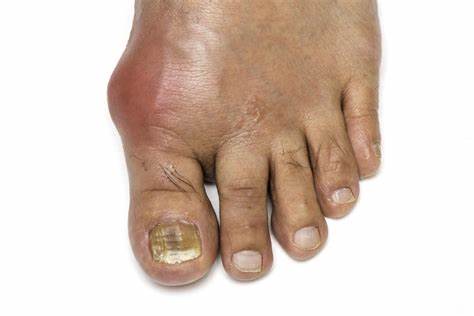 The big toe is a favorite spot for the development of gout, a metabolic inflammation of the joint that causes extreme pain. Diets rich in certain proteins and substances known as purines, dehydration, overindulgence in alcohol and coffee, red meat, shellfish, legumes and certain systemic diseases can precipitate a very painful gout attack.