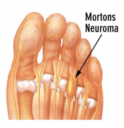 Foot Problems in Seniors. Neuromas, also called interdigital neuromas or a Morton’s neuroma, are nerve enlargements that are often found right below your toes in the front of the foot.