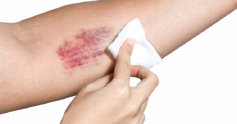 Bruising treatment. Protect your hands and arms when you think they’re in the line of fire: Special sleeves can help with this, or your doctor might suggest a cream or lotion to keep your skin from bruising or help make your skin thicker.