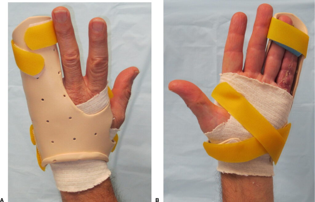 Dupuytren's Contracture, For many people, a mild case doesn’t cause major problems or pain, and it may not get worse, so your doctor might take a wait-and-see approach. If it is causing problems, they may suggest a type of stimulation with needles, shots, or possibly surgery to give you more movement in your hands. Treatment doesn’t always fix it completely, though, and it sometimes comes back.