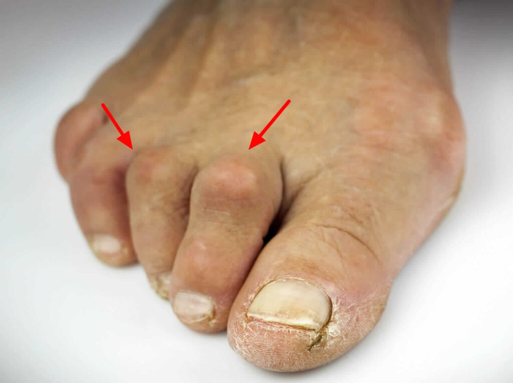 Hammertoes are very common foot deformities that can be painful, especially if a hard area of skin, known as a corn, develops over the hammertoe. Every step can be painful, especially when there is contact with the top of the shoe. The term "hammertoe" refers to a toe that points upward, rather than lying flat.