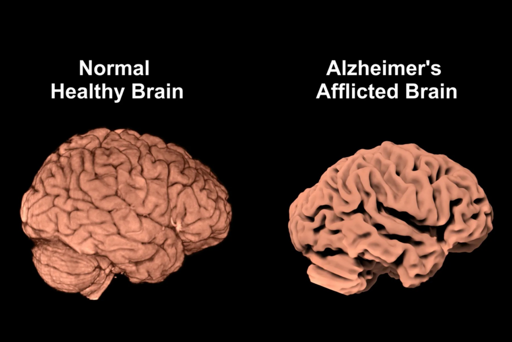 Alzheimer's disease damages cells in the brain and leads to shrinkage. 