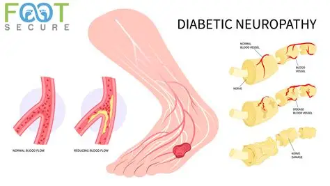 Diabetic Peripheral Neuropathy. Too-high blood sugar levels in people with type 2 diabetes can lead to nerve damage in the legs, feet, arms, and hands. This condition is called diabetic peripheral neuropathy.
