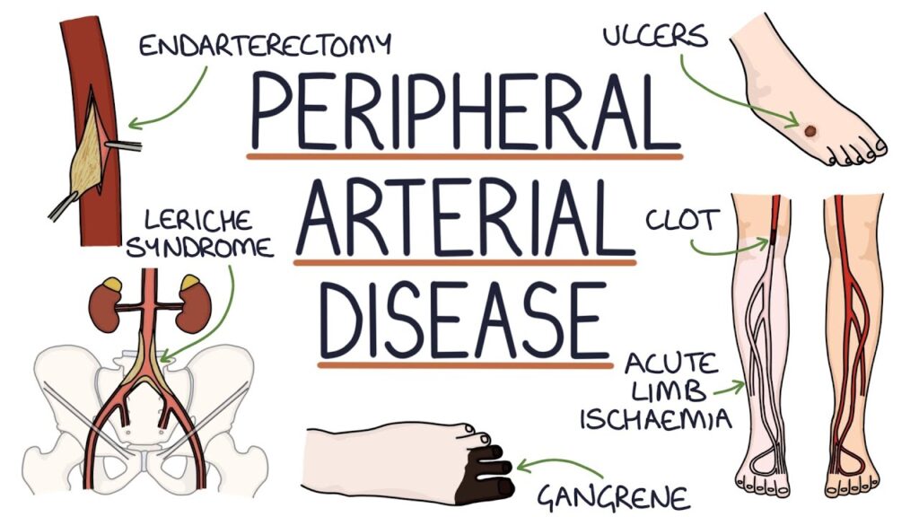 Peripheral Artery Disease (PAD). peripheral artery disease (PAD), can affect blood flow. PAD is when cholesterol clogs blood vessels in your legs. It can trigger cramps since there may not be enough blood getting to your legs.