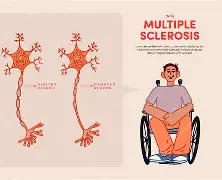 Multiple Sclerosis (MS). Leg cramps can also be a symptom of the nerve disorder multiple sclerosis (MS). Some people with MS have spasticity, which can include involuntary muscle spasms and twitches or leg cramps. 