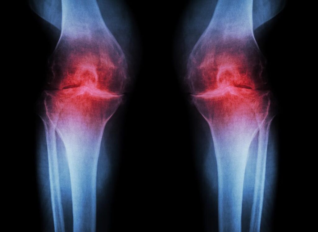 Osteoarthritis. the most common type of arthritis, is usually categorized by stiff and achy joints. People with osteoarthritis may also have muscle spasms and leg pain. Leg cramps are usually linked to osteoarthritis of the spine. 