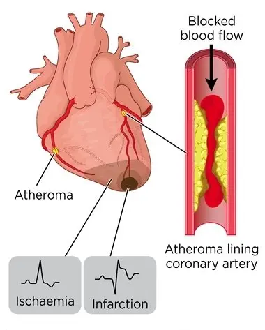 Clearing arteries. What is Arterial Calcification? It is when calcium builds up in the walls of your arteries. As a result, this often happens alongside atherosclerosis, where cholesterol, fats, and inflammatory cells also build up — forming “hard plaques.”