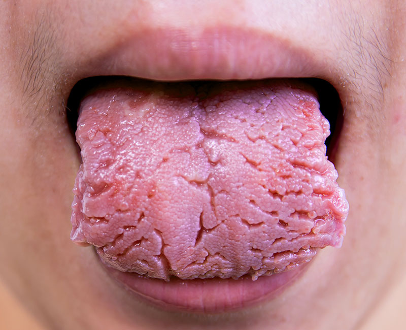 Symptoms of Dryness. Symptoms can vary from mild to severe: