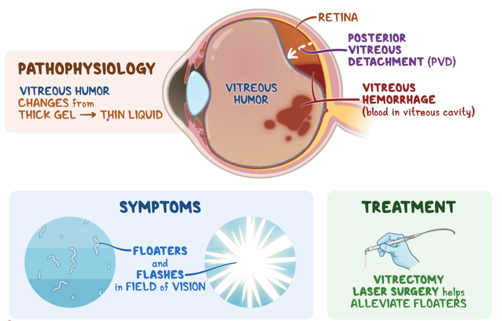 Why Are Floaters Age-Related? as we age, the vitreous gel inside the eye begins to change: